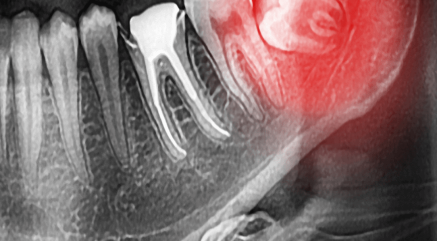 Wisdom teeth: Should you remove them if they aren’t a problem?