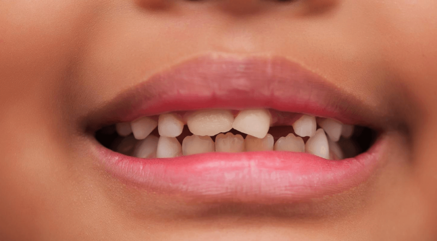 What parents should know about permanent teeth