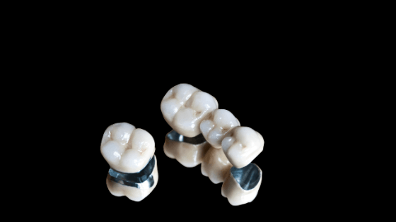 How dental restorations are created
