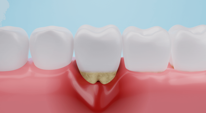 5 Ways To Prevent Receding Gums