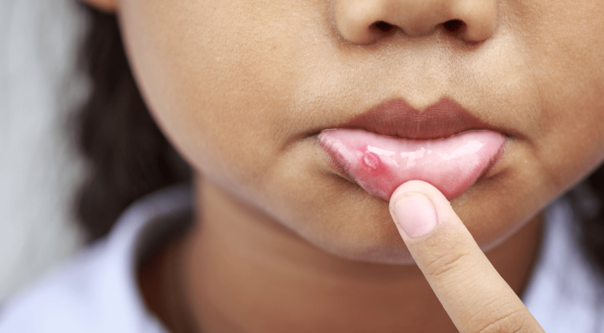 What Are The Stages Of A Canker Sore?