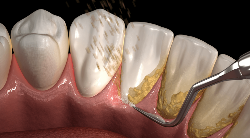 What Is Tartar And How Can I Prevent It?