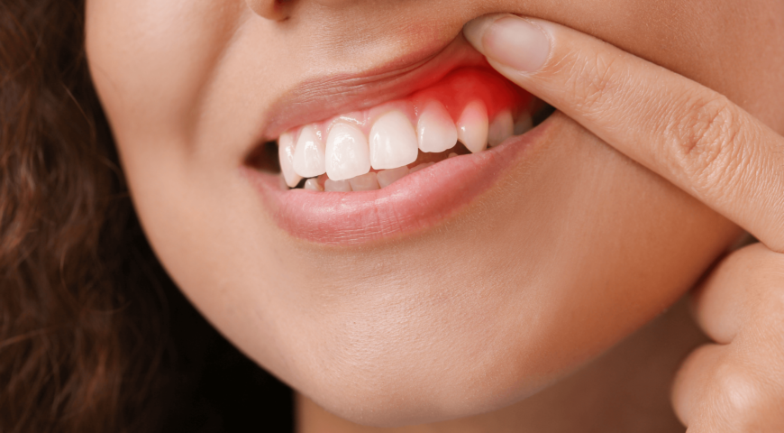 Symptoms Of Gum Disease