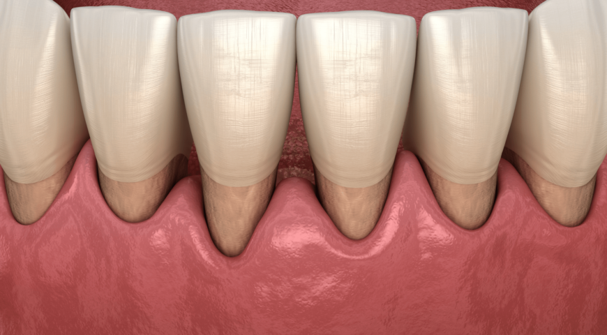 What Causes Receding Gums?
