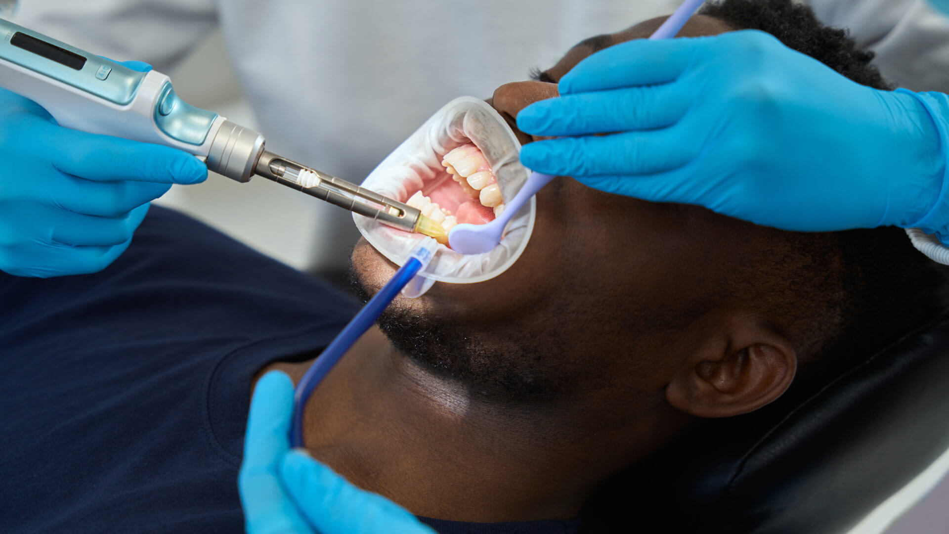 5 Myths About Dental Fillings You Wish You Knew