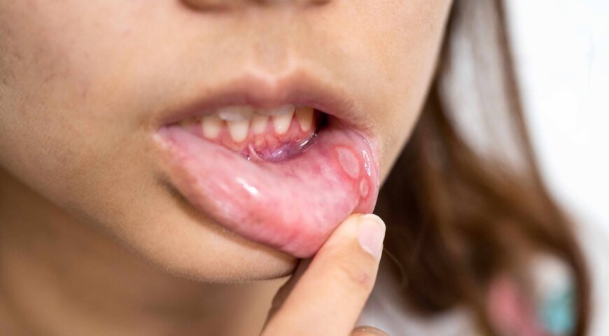 Mouth Sores: Is It An STI Or Something Else?